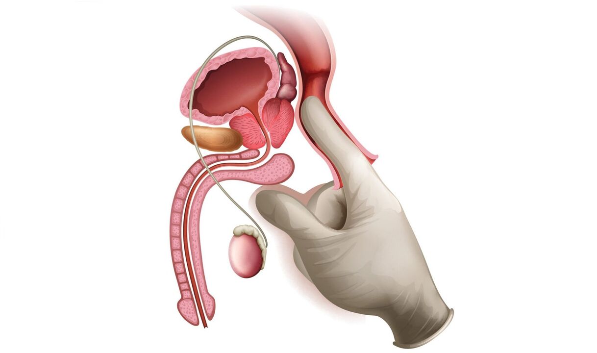 prostatas masāža prostatīta ārstēšanai